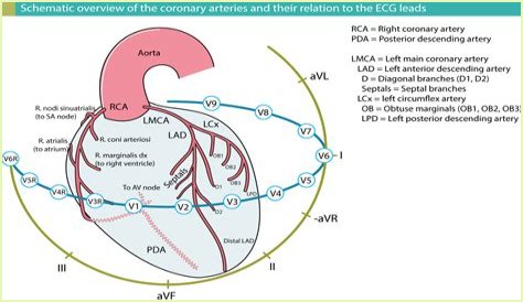 What does the medical term infarct mean?